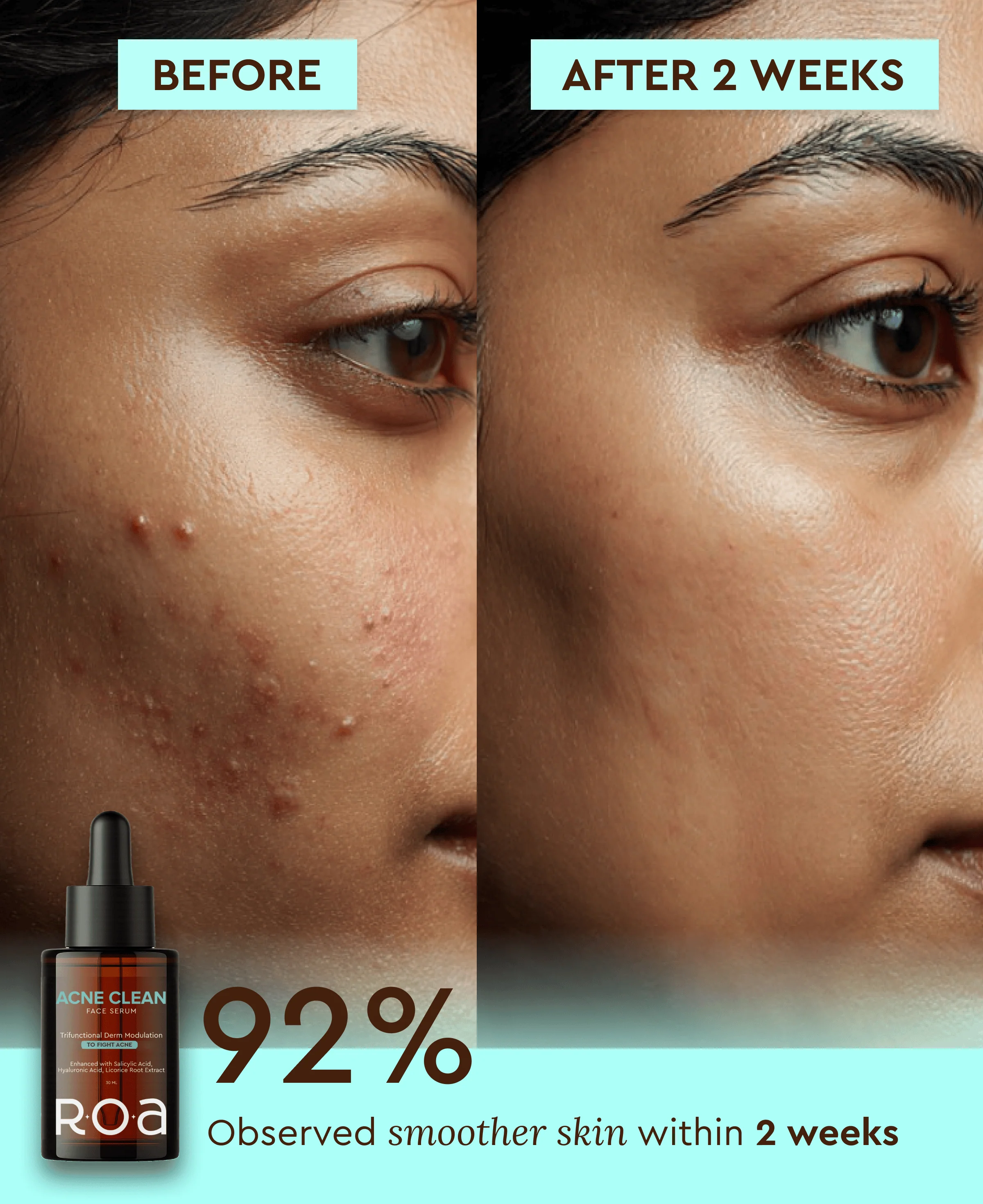 ACNE CLEAN 2% SALICYLIC ACID SERUM - Image 5