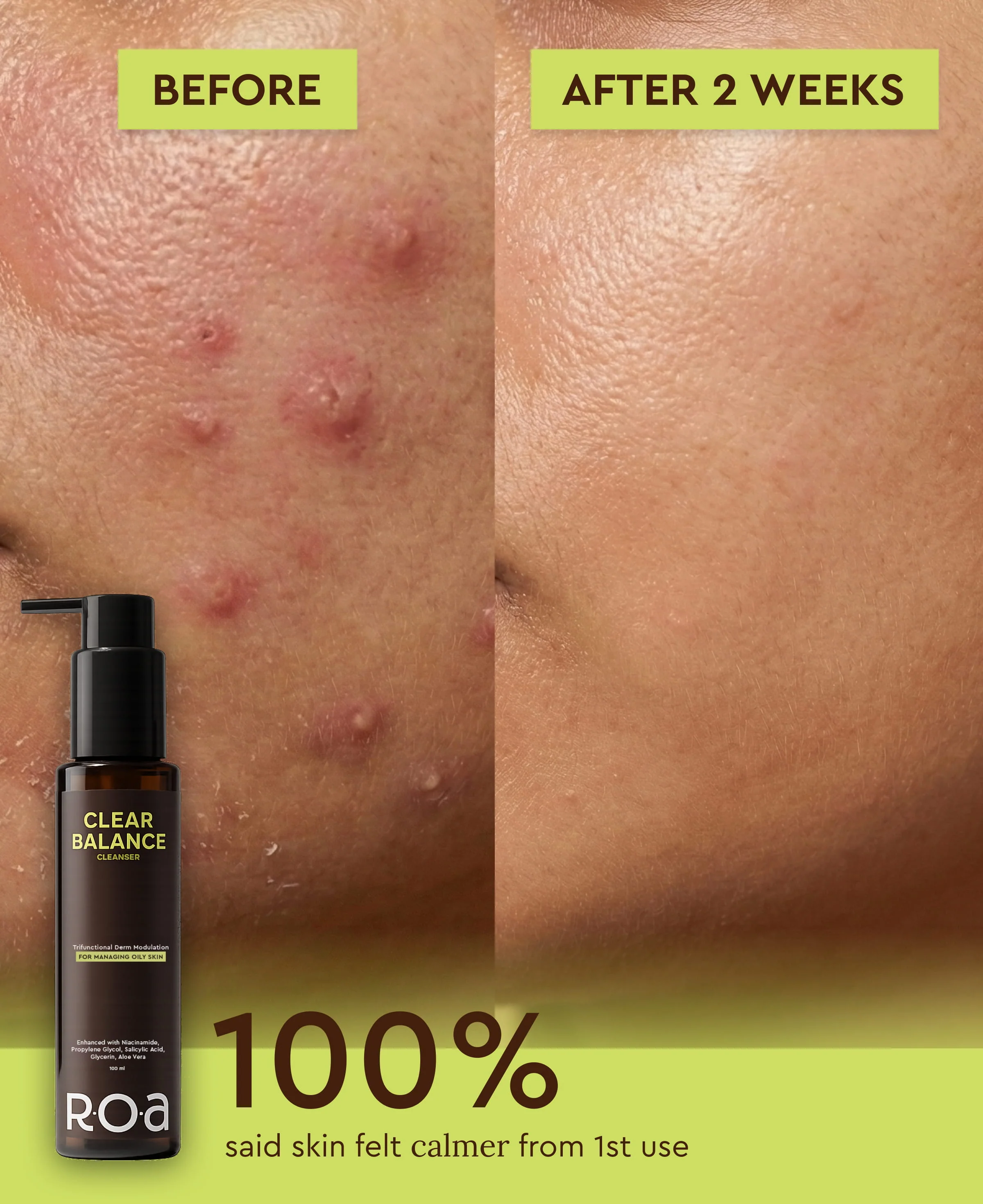 ROA SKINCARE CLEAR BALANCE CLEANSER FOR OILY ACNE PRONE SKIN - Image 3